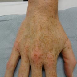 Example of pigmentation